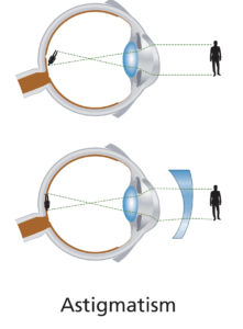  Treating astigmatism, the cornea is made more spherical