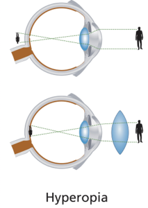 Treating farsightedness, the cornea is made steeper