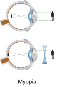 Treating nearsightedness, The Cornea is made flatter