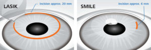 Comparison of LASIK and SMILE