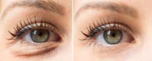 Blepharoplasty before and after